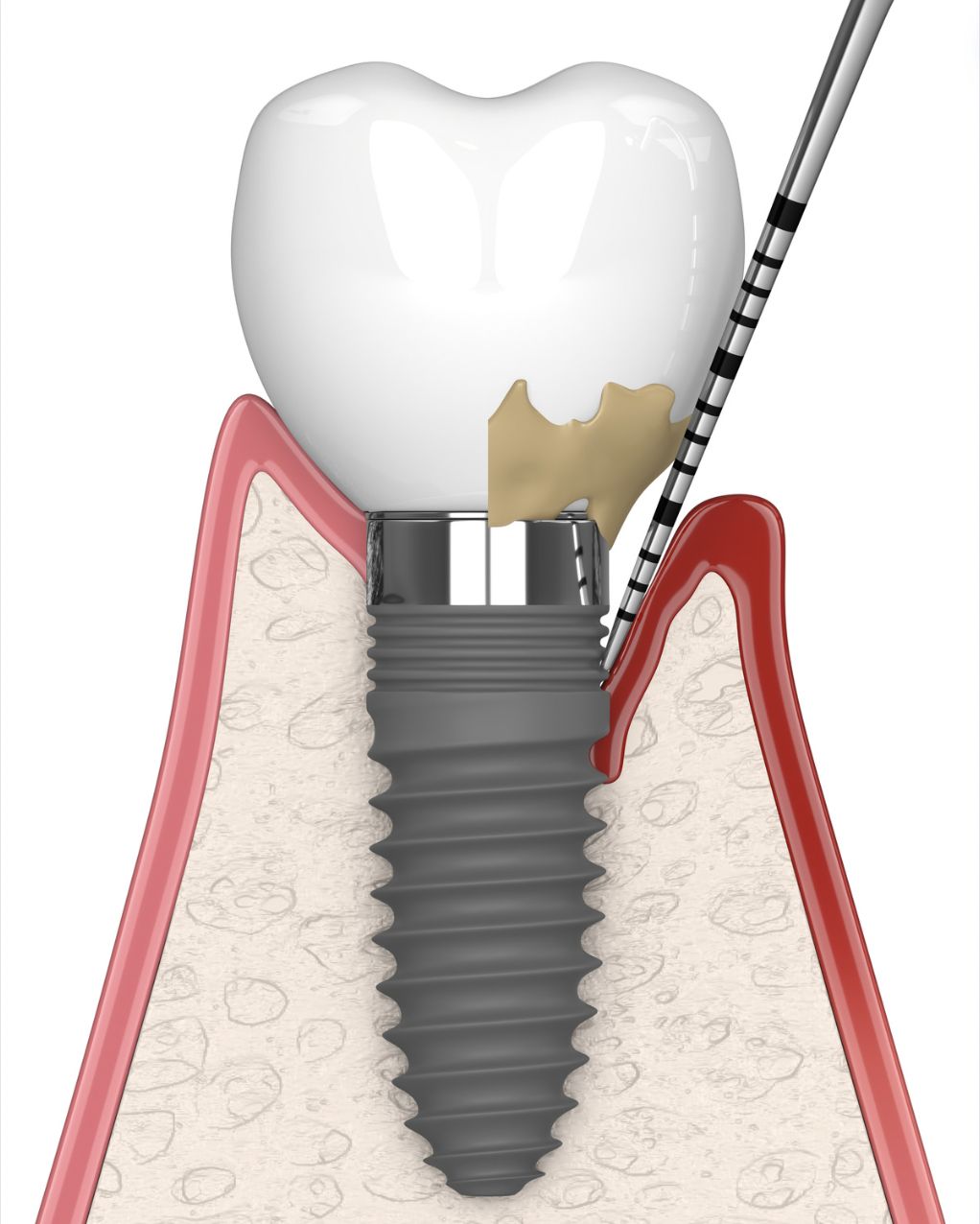 guide complet pour la prévention des péri-implantites 